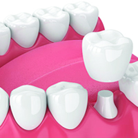 Dental crowns in Turkey