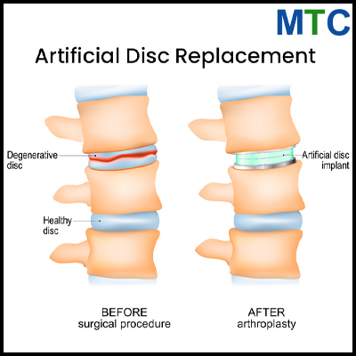 Artificial Disc Replacement in Mexico