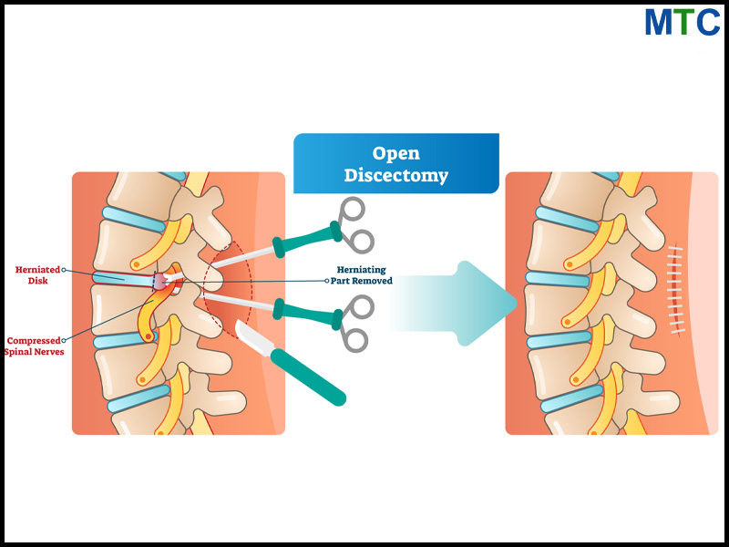 Discectomy in Mexico