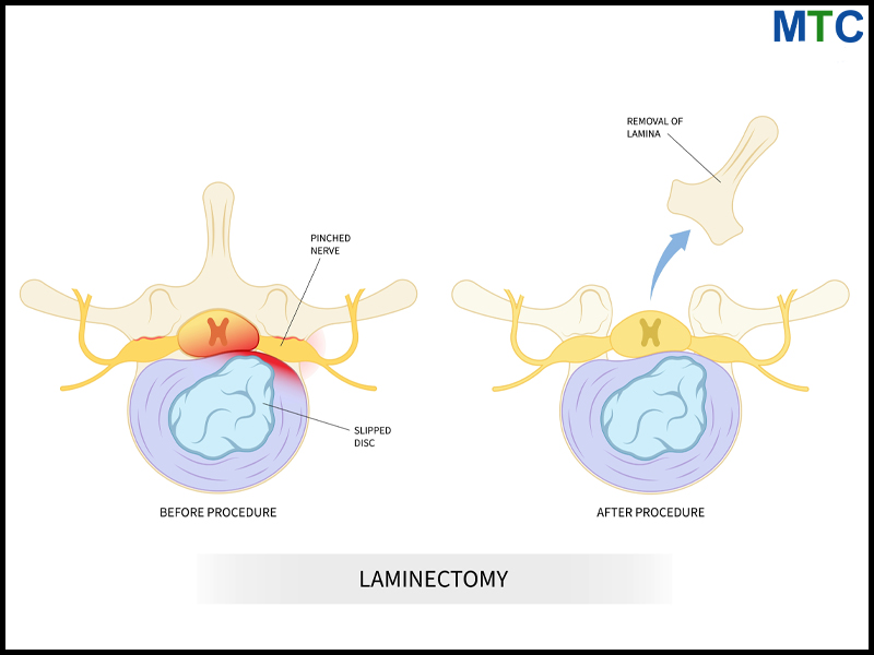 Laminectomy in Mexico