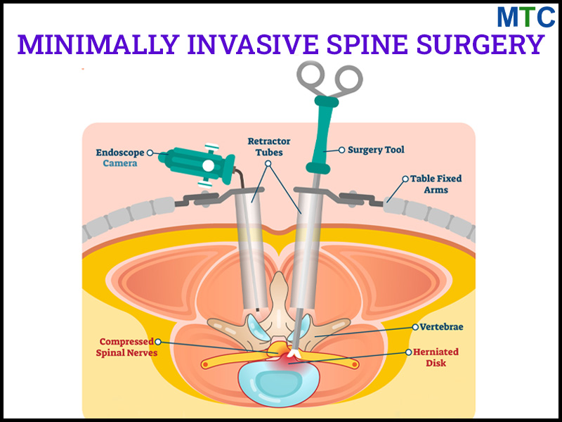 Microendoscopic Discectomy in Mexico