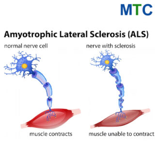 Neurological Disorders | Stem cell therapy in Mexico