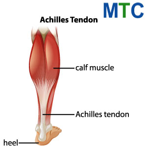 Achilles Tendon Reapir in Mexico