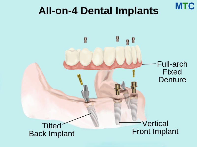 All on 4 Dental Implants