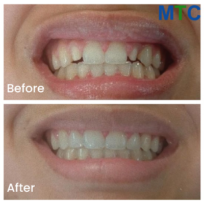 Veneers Before & After, Tijuana, Mexico