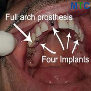 Final Prosthesis Placement