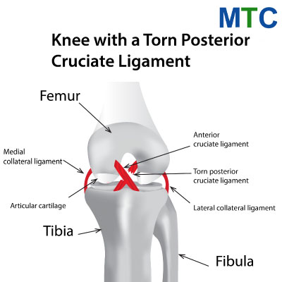 PCL Repair in Mexico