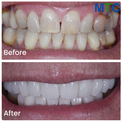 Veneers Before & After, Tijuana, Mexico