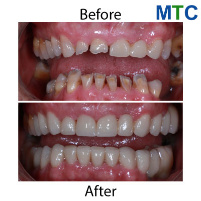 Zirconium Crowns in Bucharest, Romania: Before & After