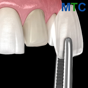 Zirconium Veneers in Cancun