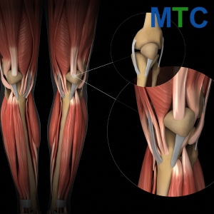 Cartilage Restoration in Istanbul, Turkey