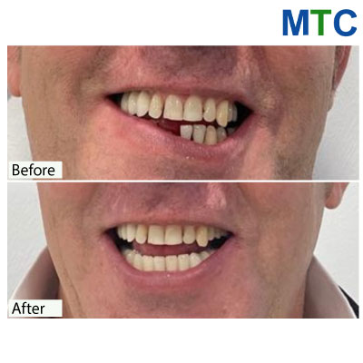 Smile Restoration with Implants & Crowns