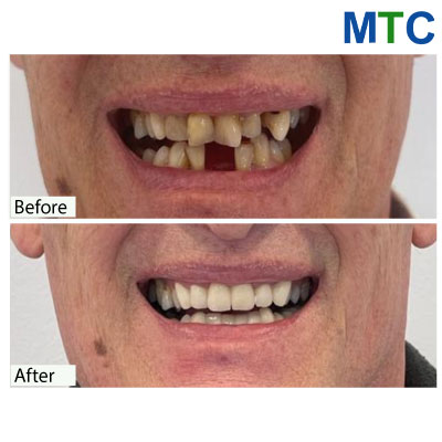 Smile Restoration with Implants & Crowns