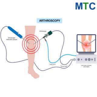 Knee Arthroscopy | Alternative to knee replacement surgery