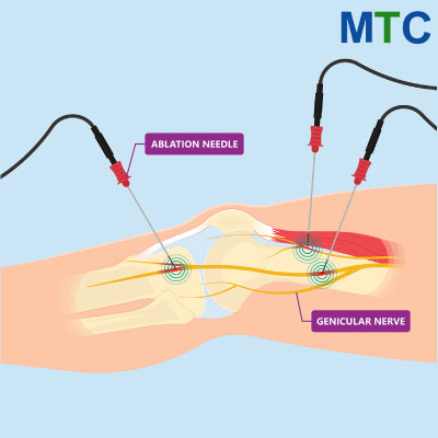 Radiofrequency Ablation (RFA) | Alternatives to knee replacement surgery