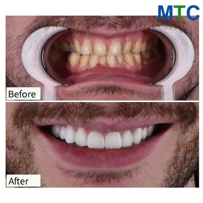 Smile Restoration with Veneers