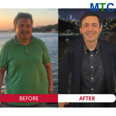 Weight Loss Surgery in Istanbul, Turkey