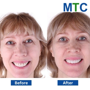 Zirconia Crowns in Algodones: Before & After