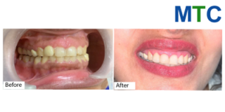 Dental Crowns in Bangalore